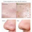 Blackhead Electric Pore Removal Machine - Facial Equipment - 6