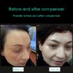 Portable Handheld Laser Plasma Beauty Pen for Tattoo Removal - 4