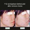 Portable Handheld Picosecond Laser Pen for Tattoo Mole Freckle Removal - 6
